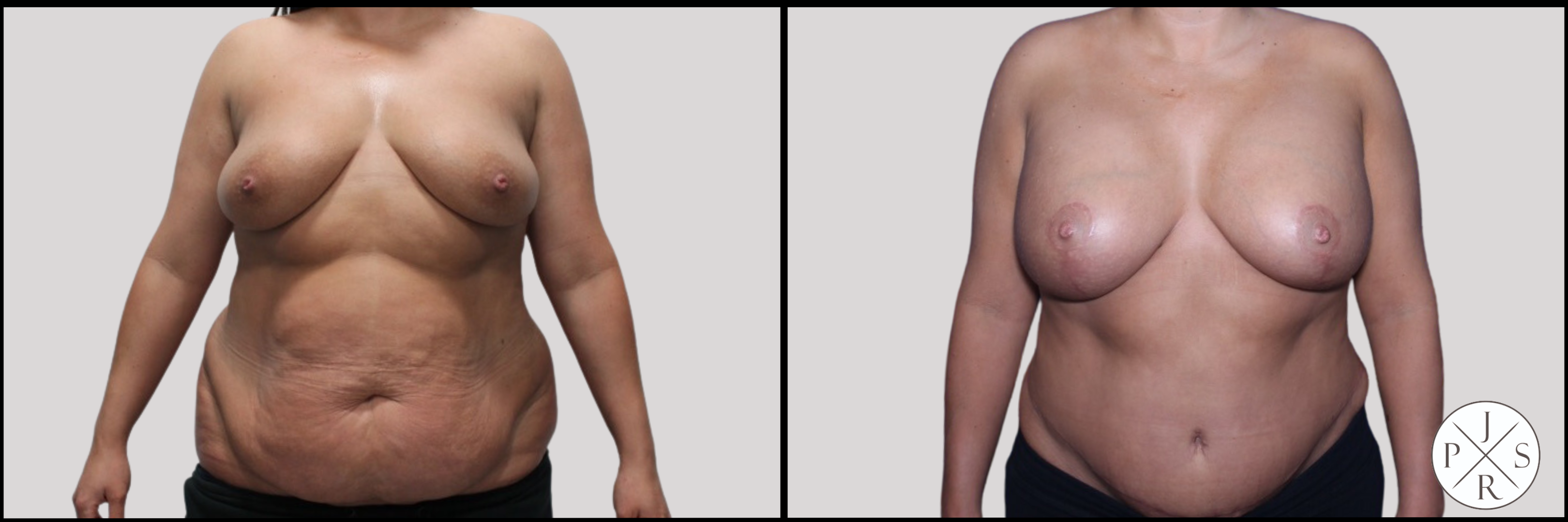 Abdominoplasty Before & After Image